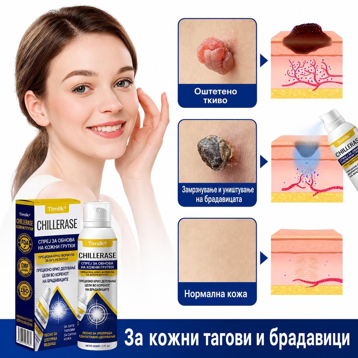 Брадавици, кожни израстоци или шилци на нога? CHILLERASE е практично решение за домашна нега