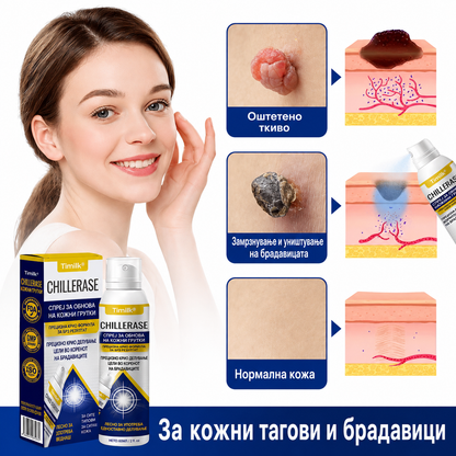 Брадавици, кожни израстоци или шилци на нога? CHILLERASE е практично решение за домашна нега