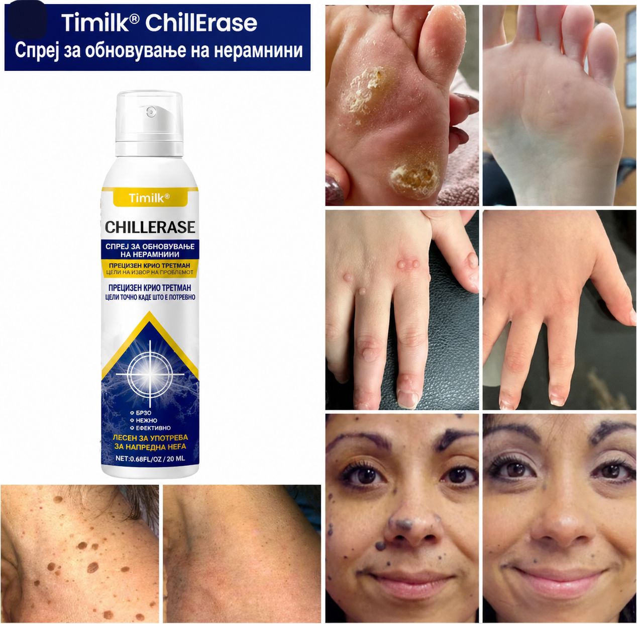 Брадавици, кожни израстоци или шилци на нога? CHILLERASE е практично решение за домашна нега